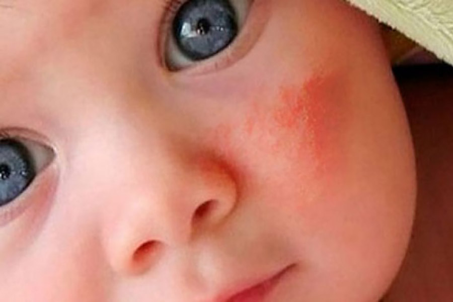 Диатез у ребенка