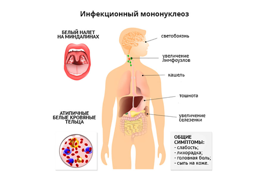 Симптомы мононуклеоза у детей
