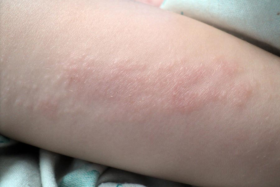 Аллергия на коже у ребенка