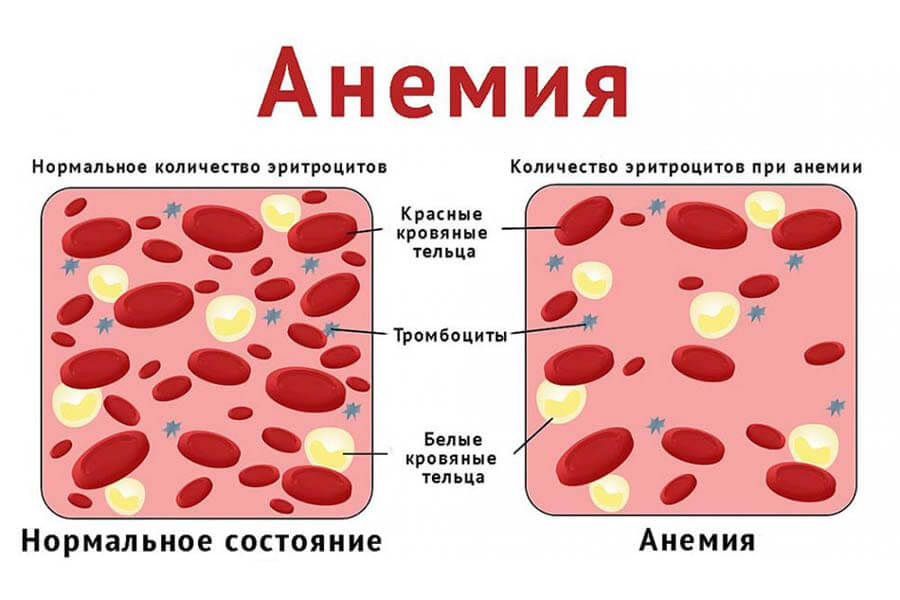 Что такое анемия?