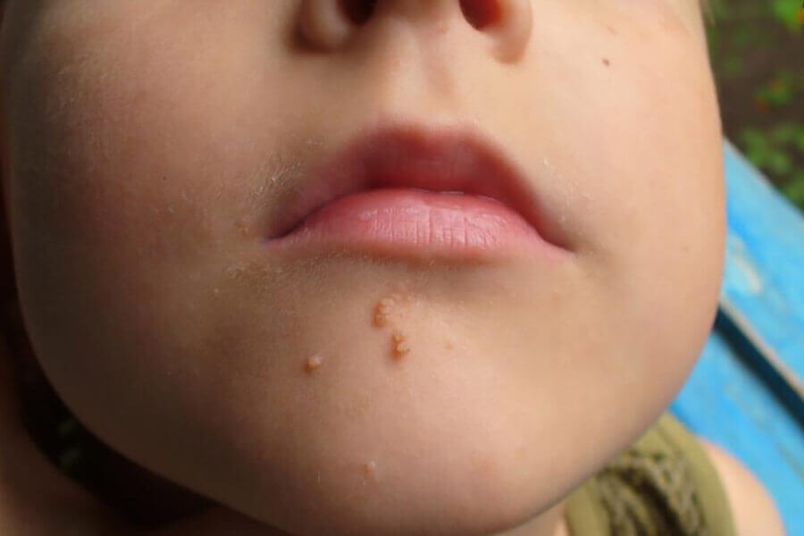 Бородавка у ребенка