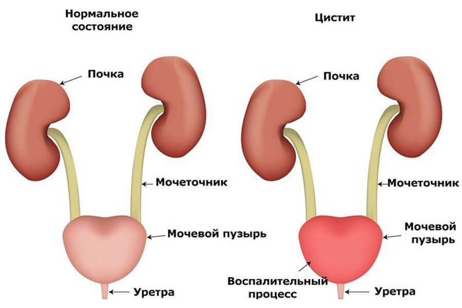 Цистит