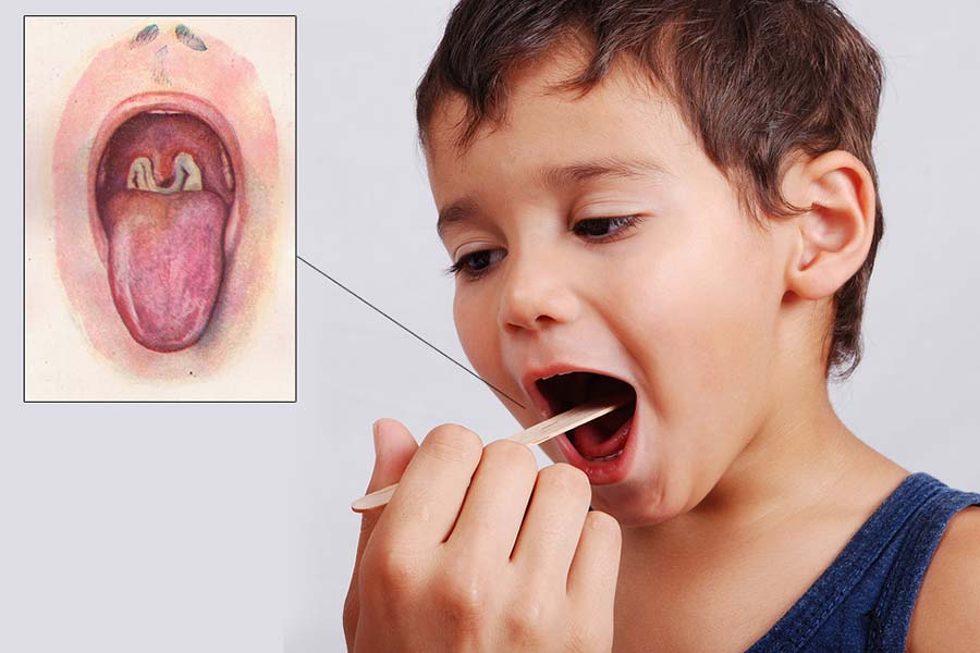 Дифтерия у ребенка