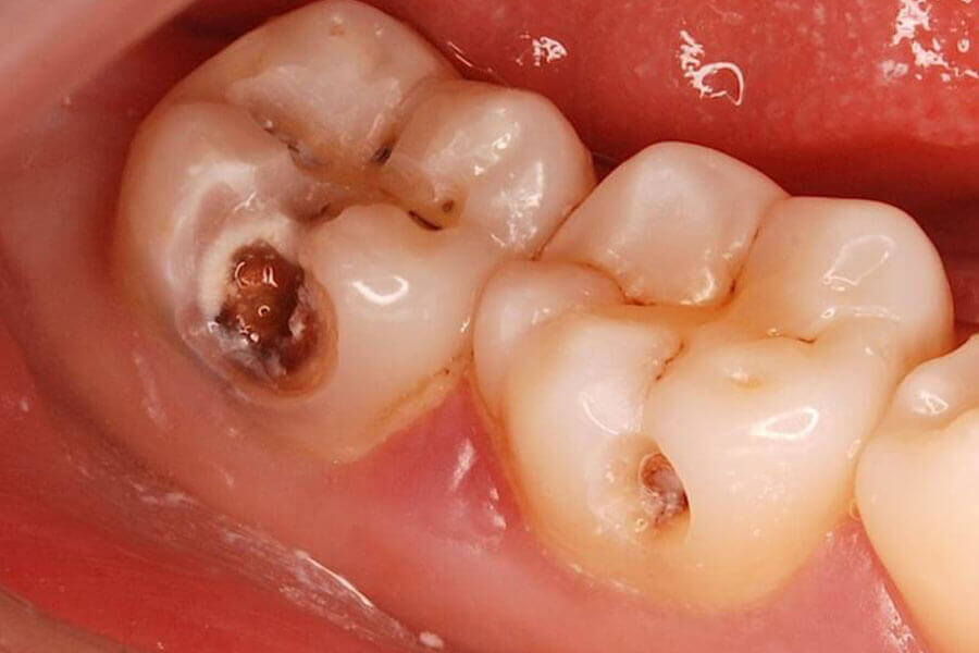 Глубокий кариес у ребенка