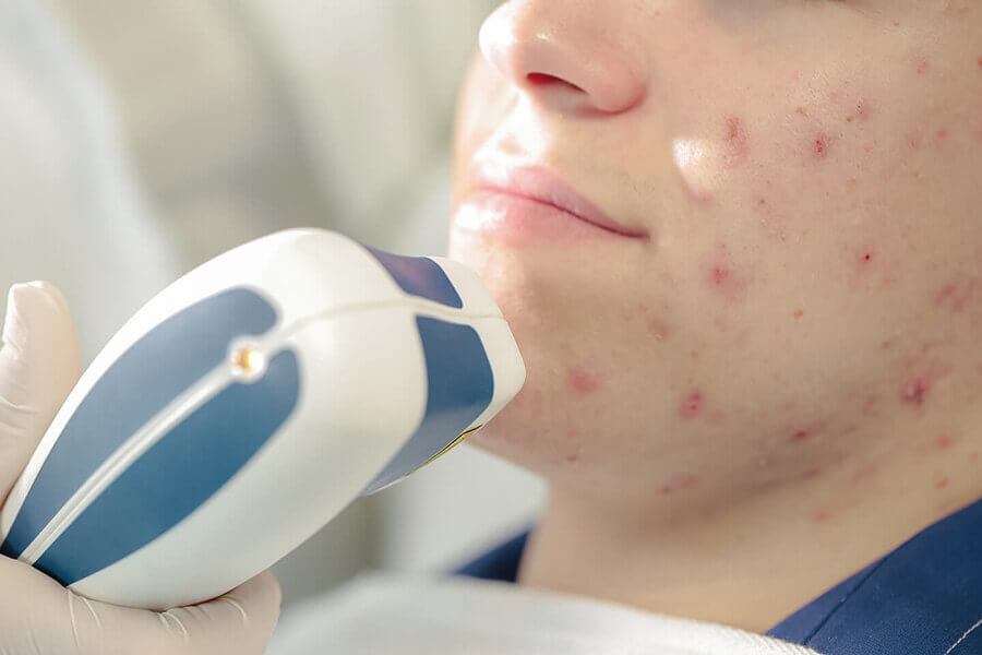 Лечение акне у подростка