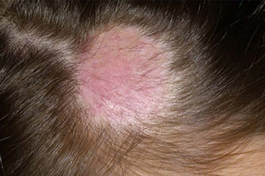 Лишай у ребенка