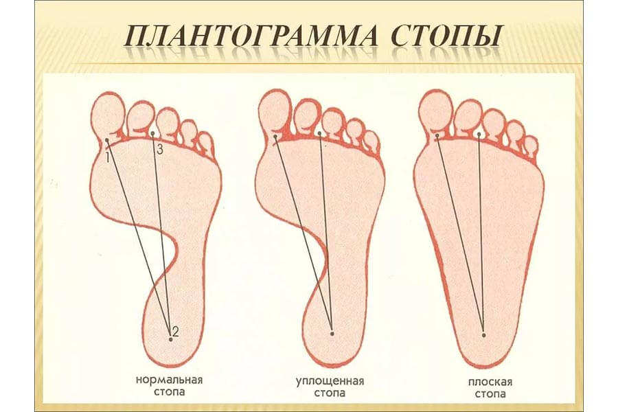 Плоская стопа