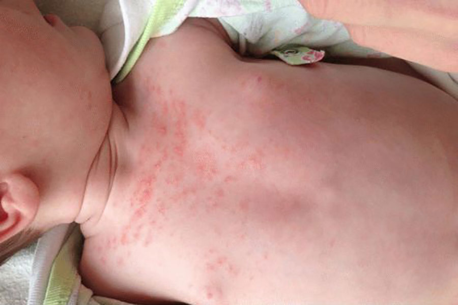 Потница у ребенка