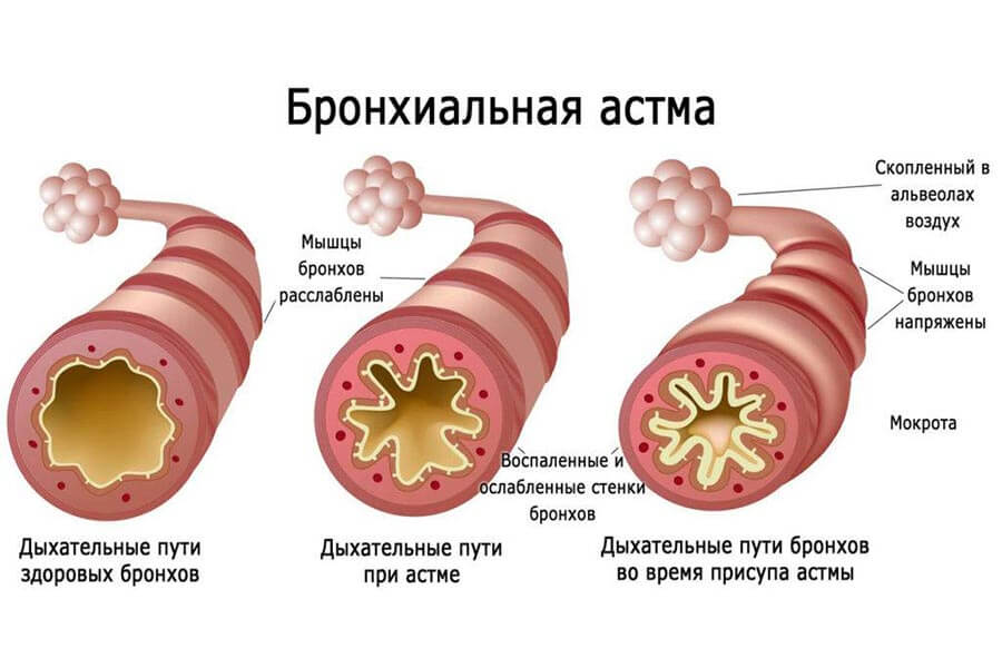 Приступ астмы