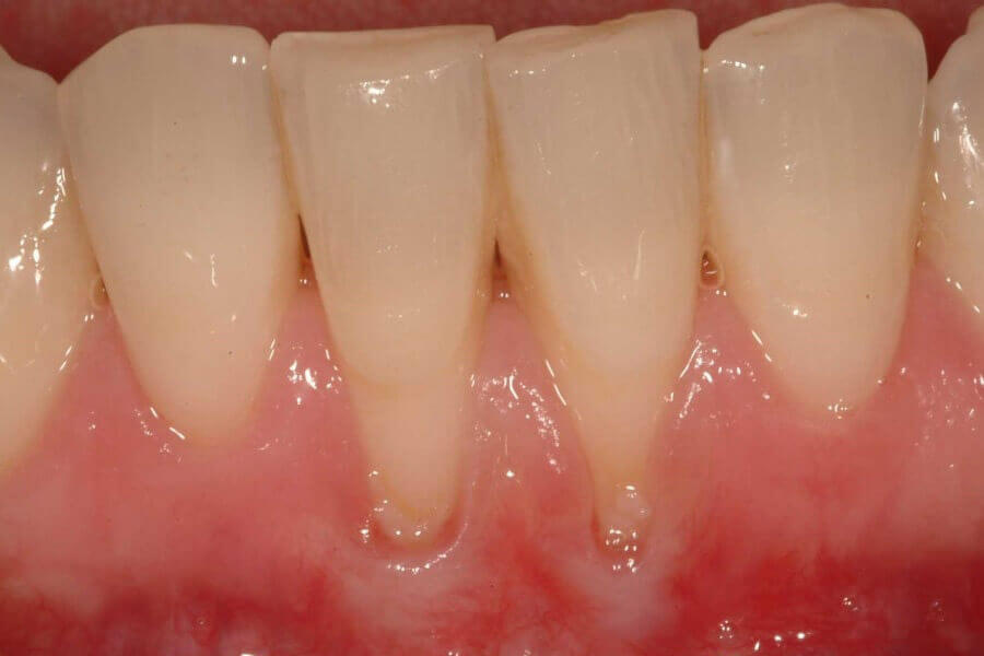 Симптомы пародонтоза у детей