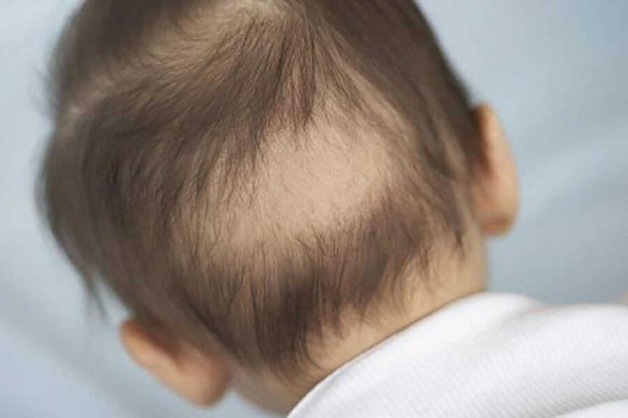 Рахит у ребенка