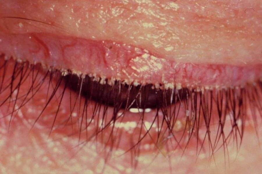 Симптомы демодекоза