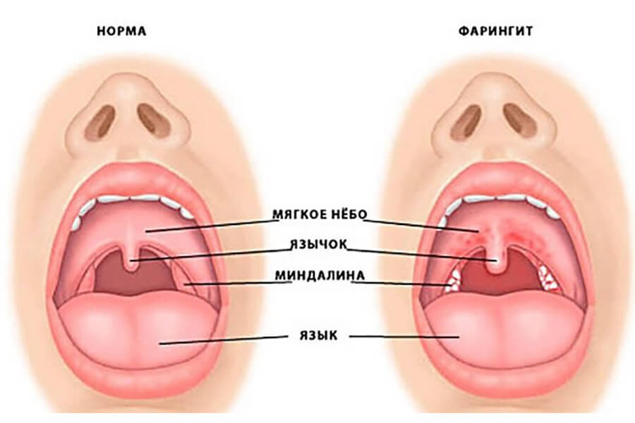 Симптомы фарингита