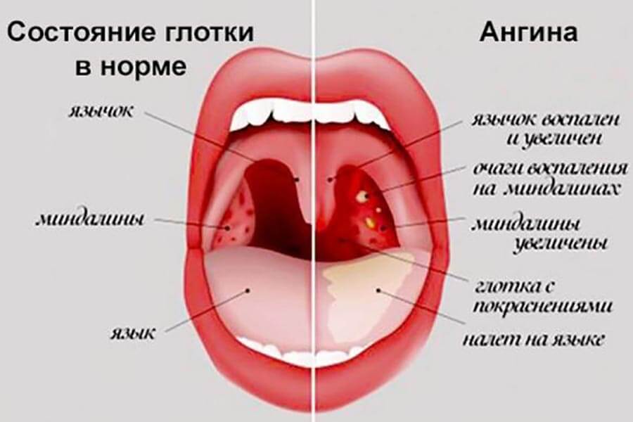 Симптомы ангины у ребенка