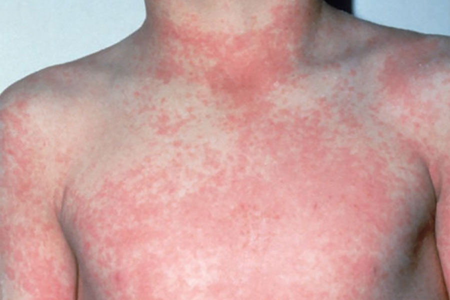 Симптомы детской розеолы