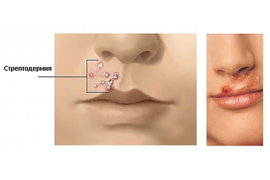 Симптомы стрептодермии