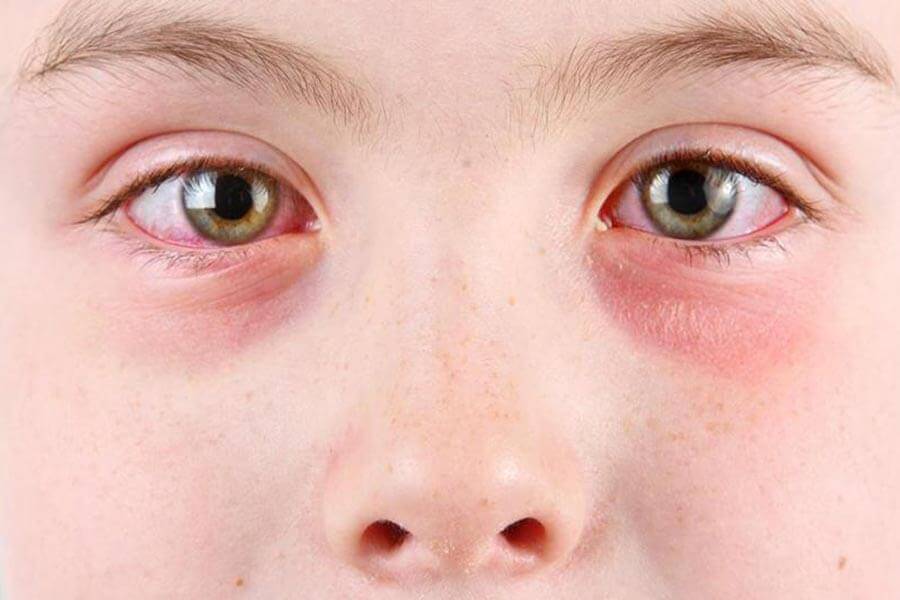 Синяки и отеки под глазами