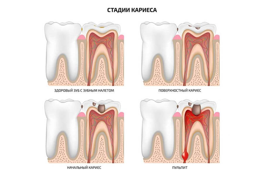 Стадии кариеса у детей