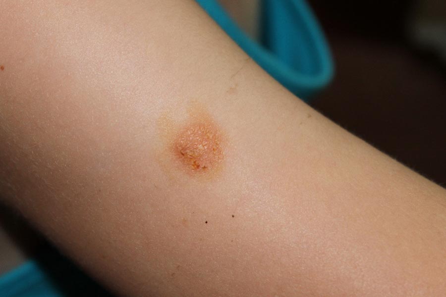 Стрептодермия у ребенка