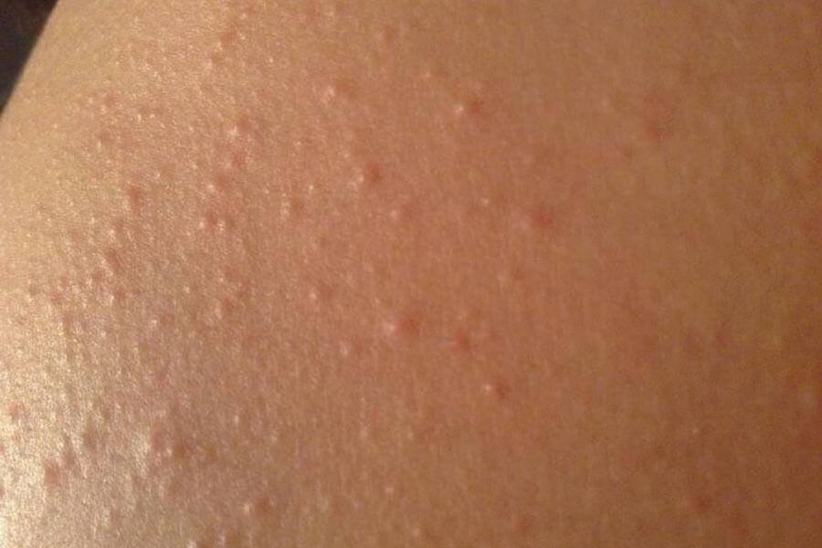 Сыпь у детей