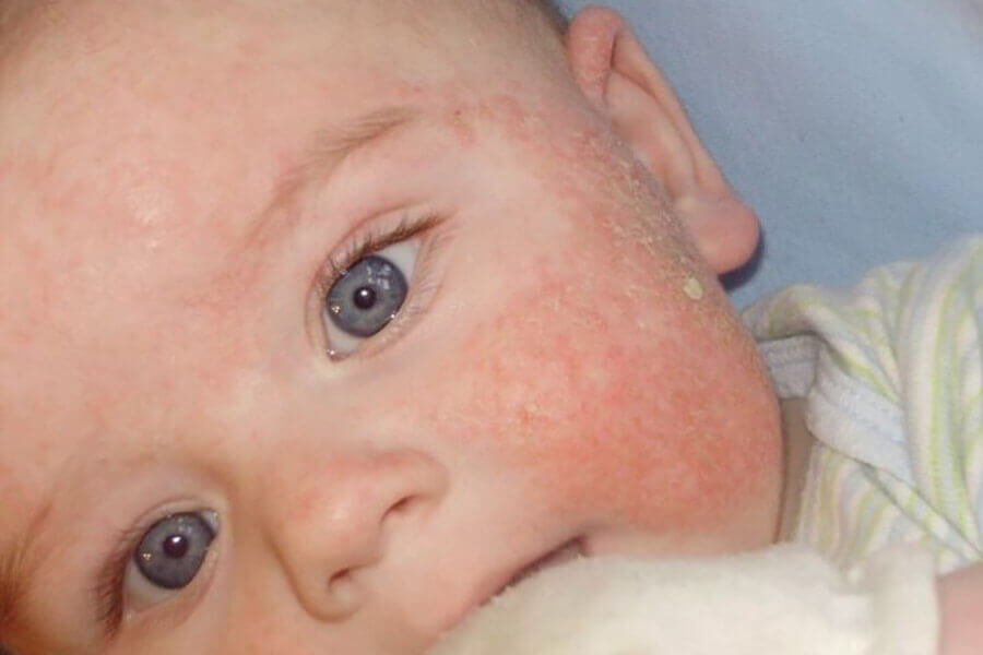 Сыпь у ребенка