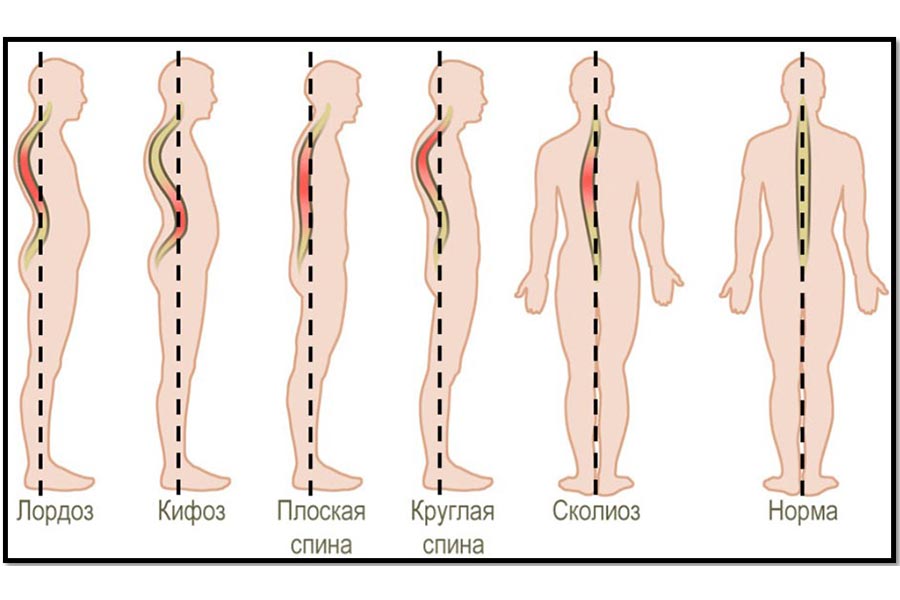 Виды искривления позвоночника