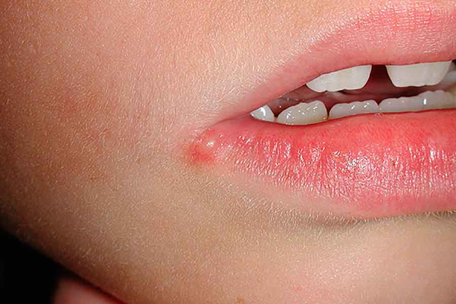 Вирус герпеса у ребенка