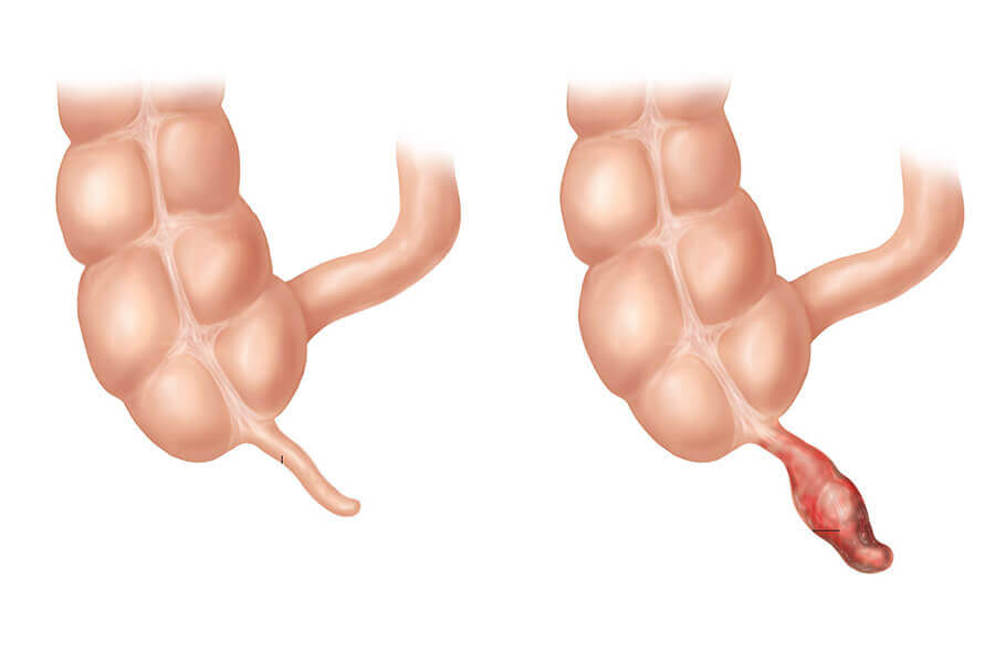 Воспаление аппендицита у ребенка
